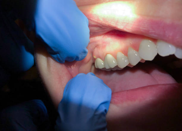 Best Broken or Cracked Tooth Emergency Dentist in Algonquin, IL